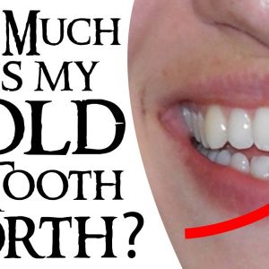 How Much is my Gold Tooth Worth?